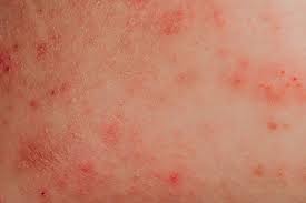 Image result for allergy rash on the legs