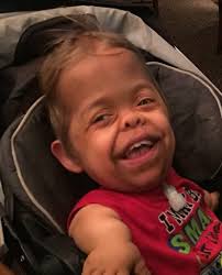 Types of Dwarfism Archives