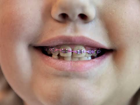 Braces For Young Kids Might Not Always Be Best : NPR