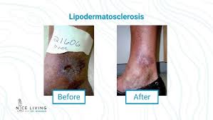 Image result for Lipodermatosclerosis