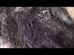 Hair Restoration محترفي إستعادة الشعر Youtube