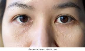 Image result for milium cyst on eyelid