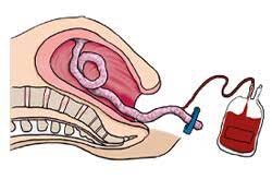 Since the first umbilical cord blood transplantation in 1988 for fanconi's anemia (1), umbilical cord blood has become a safe and dependable alternative donor graft source for use in allogeneic hematopoietic cell transplantation. Cord Blood Banking Process