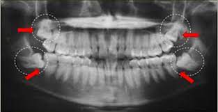 Odontocastro Os Famosos Cisos Por Que Extrai Los O Dente Do Siso Pode Originar Uma Serie De Desconfortos Ocasionados Pela Desalinhamento Com Os Outros Dentes Ou Pela Falta De Espaco Na Boca