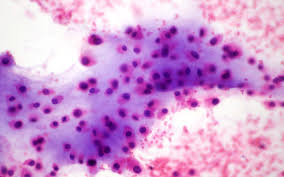 Image result for Chondrosarcoma