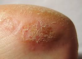 Image result for dermatitis contacta allergica