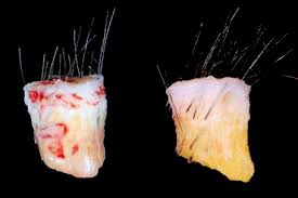 When a follicle scarring process appears to be the cause of a patient's hair loss, a scalp biopsy is often necessary to establish or confirm a diagnosis. Diseases Of The Hair Basicmedical Key