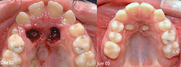If a canine is associated with severe resorption of the root of the incisor, an open exposure is not indicated since it endangers the vitality and existence of the incisor. Surgical Technique Dr Sylvain Chamberland Orthodontiste