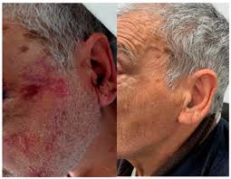 Image result for Strangulation Injury