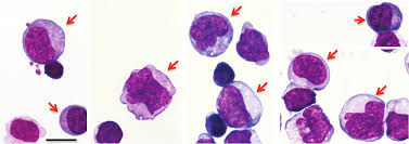 The Nature and Clinical Significance of Atypical Mononuclear Cells in  Infectious Mononucleosis Caused by the Epstein-Barr Virus