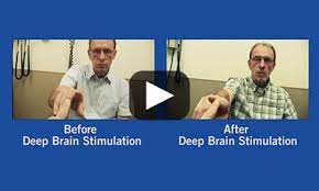 Parkinson S Movement Disorders Program