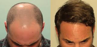 Tutte le immagini prima e dopo del trapianto capelli dei nostri clienti che hanno deciso di condividere la loro esperienza con istituto helvetico sanders. Trapianto Capelli Venezia Non Basta E Non Cura Hairclinic