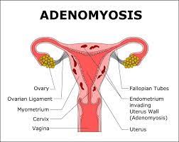 Adenomyosis Causes Pain Heavy Periods And Infertility But You Ve Probably Never Heard Of It