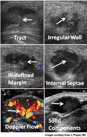 If left unchecked, the cancer can break out of the lymph node and spread to the surrounding. A Better Method For Diagnosing Midline Neck Masses Enttoday