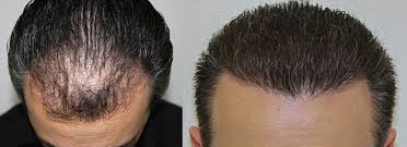 Other specialists in hair loss in los angeles county. Hair Transplant Repair In Los Angeles Ca Alvi Armani Hair Transplant Los Angeles