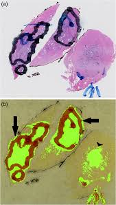 How cancer can spread to other areas of the body. Hyperspectral Imaging And Quantitative Analysis For Prostate Cancer Detection