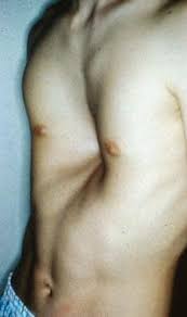 Image result for Pectus Excavatum
