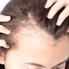 Muscle ache, rapid heart beat, wait gain, hair loss, coughing, sinusitis, soar throat and mood swings. How Is A Low High Blood Pressure Related To Hair Loss Ahs India