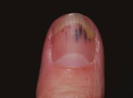 Image result for Mees Line