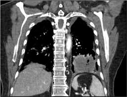 Image result for Lung Abscess