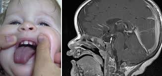 Development of the Craniofacial Blood Supply: Extracranial System