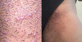 علاج شعر العانة المغروز تحت الجلد مجلة وسع صدرك