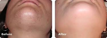 You also have to be really regular with your appointments because your hair. Laser Hair Removal For Barrie Collingwood On Spa Lumina