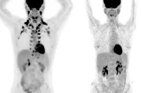 5 ways to increase brown fat. Brown Fat Appears To Protect Against Disease Cell And Molecular Biology