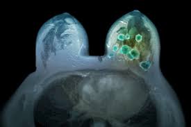 Inflammatory breast cancer doesn't have to have a lump. Breast Cancer Cancer Therapy Advisor