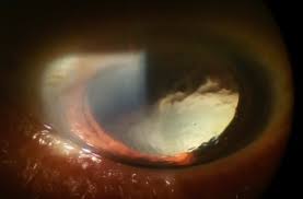 Image result for Lens Dislocation