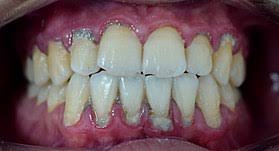 Dental plaque is the covering of a film of bacteria and sugar formed on your teeth and is the main cause of gum disease. Calculus Dental Wikipedia