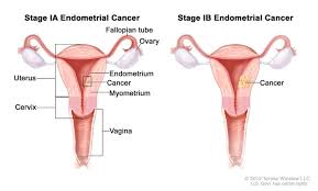Most cancer screening is specific to certain age groups and your primary care doctor will know what screening to perform depending on your age. Uterine Cancer General Information Symptoms Signs Of Endometrial Cancer Cleveland Oh University Hospitals