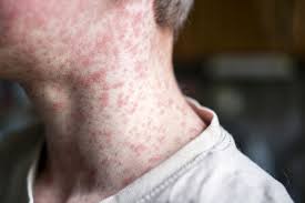 Image result for Generalized Rash