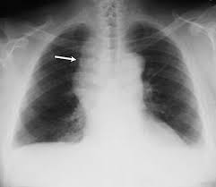 Check spelling or type a new query. Pleural Effusion Pulmonary Disorders Msd Manual Professional Edition