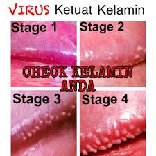Ubat sifilis di farmasi de nature untuk kencing kotor. Ubat Untuk Ketuat Di Farmasi Rawatan W