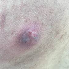 Image result for Merkel Cell Carcinoma