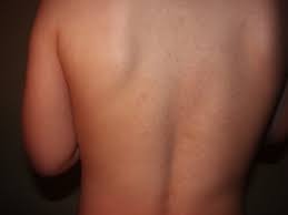 Ringelroteln Erythema Infectiosum Deximed
