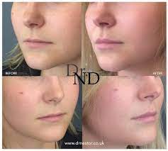 Check spelling or type a new query. Lip Augmentation The Pmfa Journal