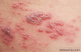 Image result for shingles
