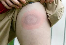 Image result for Tick Bite
