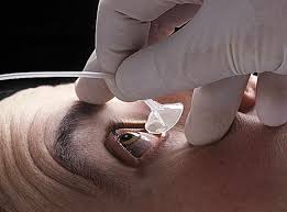 Image result for Eye Irrigation