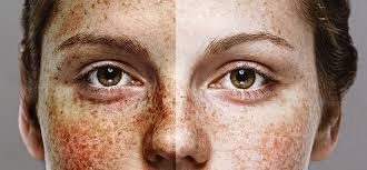 Image result for what is the best treatment for sun damaged skin?