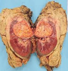 This could be to lymph nodes, the lungs, liver, bone, or even the vena cava — the largest vein in your body. Kidney Disease Treatment In India Kidney Cancer Therapy In Tamil Nadu Renal Cell Cancer Treatment Madurai