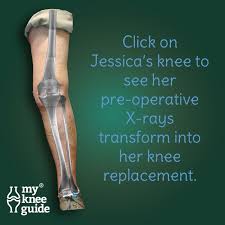 Jessica Jessica Could No Longer Play Golf With Her Knocked Knee Knee Replacement Recovery Knee Replacement Surgery Knee Replacement Surgery Recovery