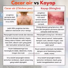 Tumbuk daun semambu ngan kunyit pastu tenyeh ke di bahagian chickenpox. Klinik Sabah Apa Beza Antara Cacar Air Chicken Pox Facebook