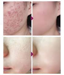 Anti Spots Pickel Entfernung Mitesser Creme Schrumpfen Poren Rtopr Mango Akne Narben Entfernen Creme Buy Narbe Radiergummi Creme Gesicht Narbe Entfernung Creme Product On Alibaba Com