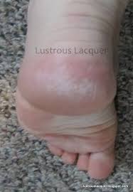 A small tub to soak them in. The Vinegar And Listerine Foot Bath Test Em Lustrous Lacquer Em