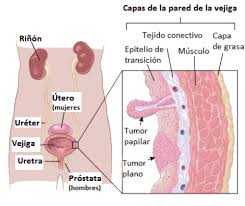 Si Usted Tiene Cancer De Vejiga