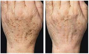 老人斑的天然靈丹竟然是這個 老人斑竟然能慢慢全部被擦走 sharetify healthy fruits healthy tips natural cures