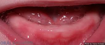 Teething Baby S Gums Baby Teeth Teething Gums Baby Gums